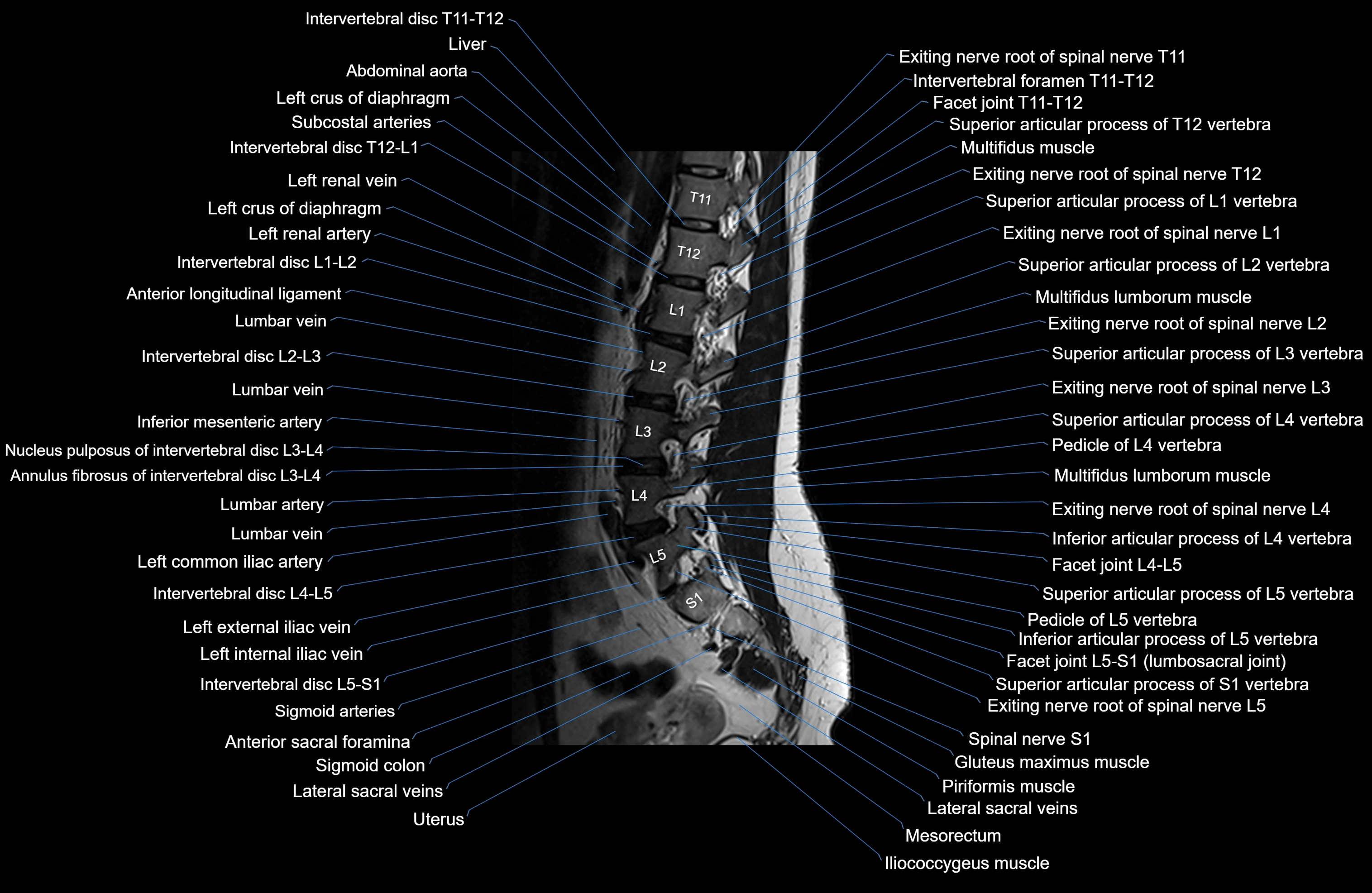MRI lumbar spine sagittal cross sectional anatomy 3T radiology  image-img-00001-00020.webp